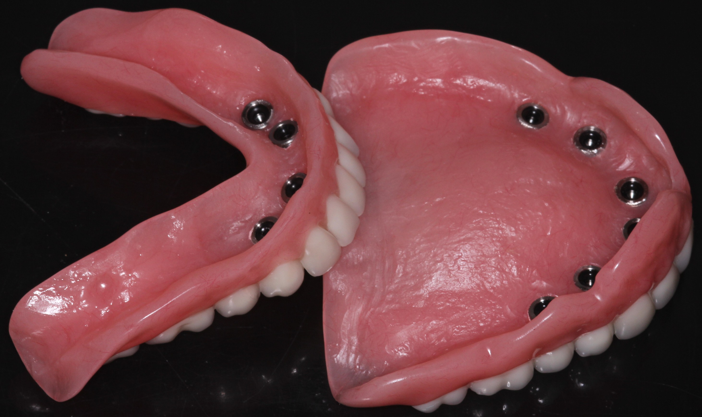 Implant Supported Dentures - Matthews, NC & Charlotte, NC