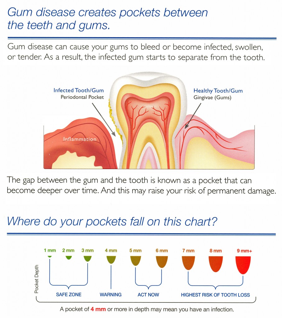 Gum Disease Pockets & Gum Recession - Matthews, NC & Charlotte, NC